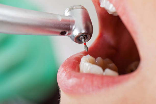 Best Emergency Wisdom Teeth Removal in Woods Cross, UT